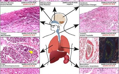 First case of postmortem study in a patient vaccinated against SARS-CoV-2