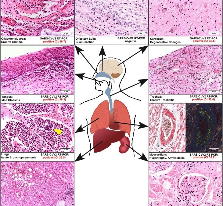 First case of postmortem study in a patient vaccinated against SARS-CoV-2